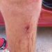 Atleta é baleado na perna após confusão em jogo de futebol em Campo Bom