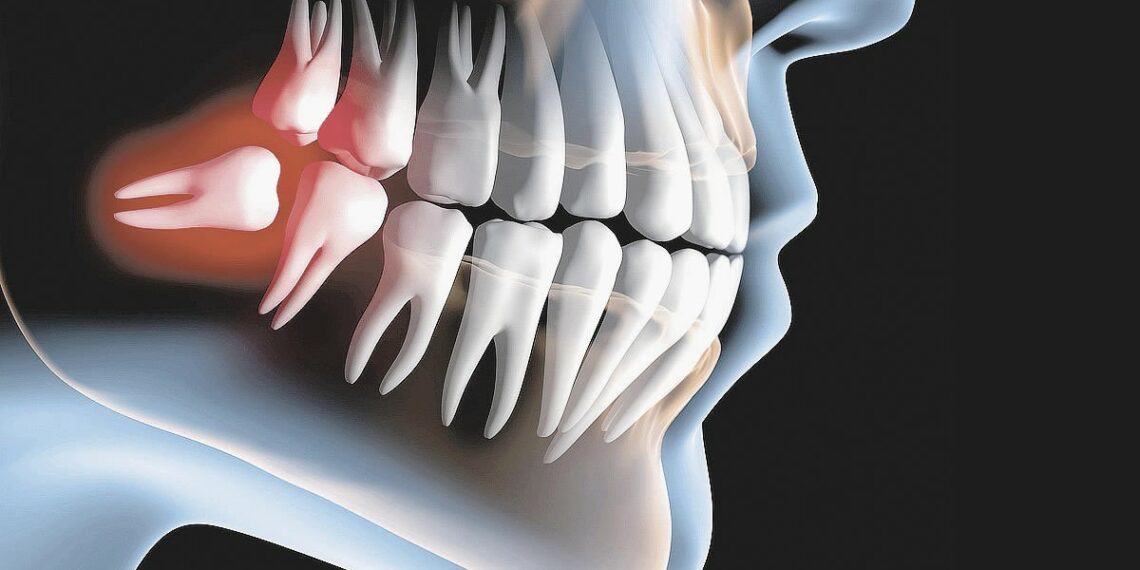 Guia Saúde e Beleza 2024: LeffaOdonto explica o que são os dentes sisos