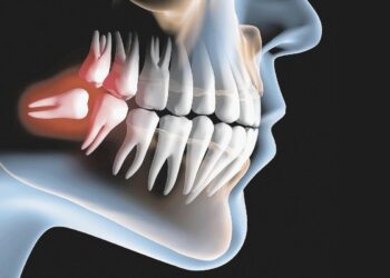 Guia Saúde e Beleza 2024: LeffaOdonto explica o que são os dentes sisos