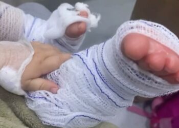 Bebê sofre queimadura de segundo grau em escola de Campo Bom