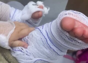 Após 15 dias no hospital devido a queimaduras, bebê de um ano recebe alta