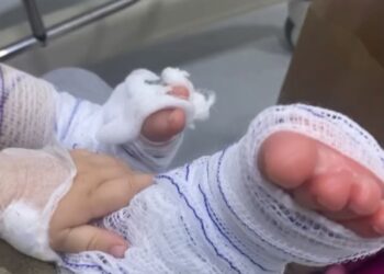 Delegada começa a ouvir envolvidos no caso de bebê que sofreu queimaduras em escola de Campo Bom